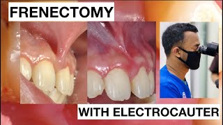 Frenectomy with Electrocauter cause teeth Gaps  General Dentist Griya RR [upl. by Cristobal]