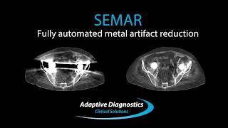 Improve CT Image Quality with Canon Medical’s SEMAR [upl. by Dranek]