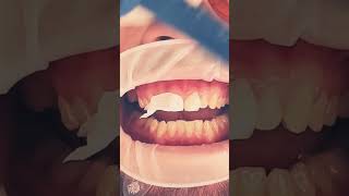 Veneers before and after video dentistteeth shorts [upl. by Acirederf199]