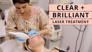 I Tried the Clear  Brilliant Laser Treatment [upl. by Aivatra]