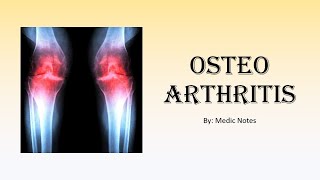 Ortho Osteoarthritis  risk factors causes signs amp symptoms xray findings treatment [upl. by Giacamo323]