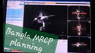 BANGLA MRI MRCPMAGNETIC RESONANCE CHOLENGIO PANCREATOGRAPHY PLANNING PHILIPS 3T mri philips [upl. by Pincince18]