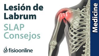 Consejos para solucionar la lesión labrum de hombro SLAP [upl. by Partan]