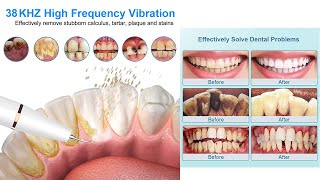 Tartar Remover Deep Cleaning With Tartar Build Up At The Dentist [upl. by Reg777]