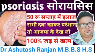 psoriasis ka ilaj 👉सोरायसिस को जड़ से खत्म करें 👉50 रुपये में👉क्यों नहीं ठीक होगा 💯 ठीक होगा [upl. by Mimi]