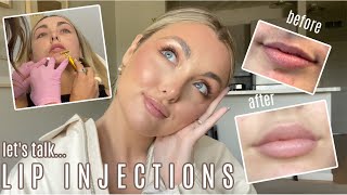 FIRST TIME GETTING LIP INJECTIONS  cost pain everything you need to know [upl. by Eirrem]