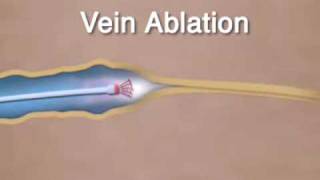 Varicose Vein Ablation amp Closure [upl. by Medardas]