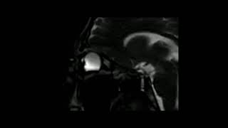 Keratoconus Eye rubbing MRI Keratocone frottements oculaires IRM [upl. by Lisha]