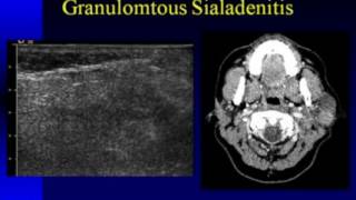 Ultrasound Imaging of the Salivary Glands [upl. by Marciano83]