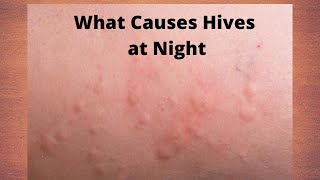 What Causes Hives at Night [upl. by Izawa694]