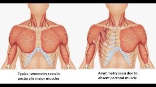 Polands Anomaly  Absence of pectoralis major Associated features Causes Diagnosis and treatment [upl. by Attenohs]