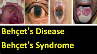 Behçet’s disease  behçet’s syndrome cause symptoms pathology diagnosis and treatment [upl. by Calvin]