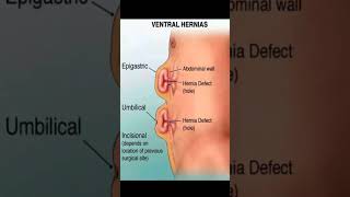 Ventral hernias motivation subscribe subscribe [upl. by Town216]