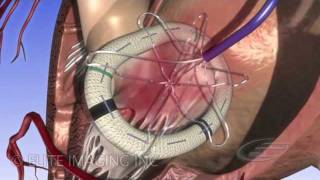 Mitral Heart Valve Ring  Medical amp Scientific Video Production [upl. by Ladnyk761]