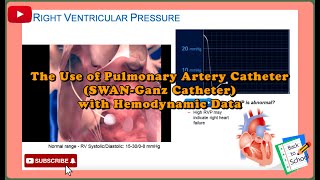 The Use of Pulmonary Artery CatheterPAC┊SWANGanz┊Medical┊Nurse┊Doctor┊ECMO┊Heart┊IABP┊Impella [upl. by Larimor997]