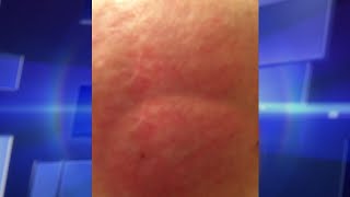 Skin Rash Leads to Shocking Diagnosis [upl. by Hazlett313]