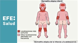 Estrategias terapéuticas frente a la dermatitis atópica [upl. by Eilagam]