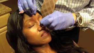 NonSurgical Nose Job Rhinoplasty by Washington DC Specialist Dr Naderi [upl. by Gniw399]