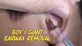 Boys Giant Earwax Removal [upl. by Adaiha611]