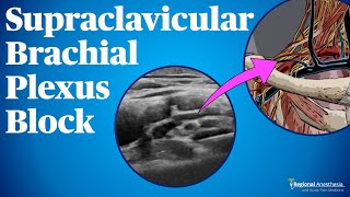 Supraclavicular Brachial Plexus Block [upl. by Navac]