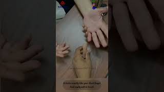 Prosthetic silicone fingerhow to wear silicone finger [upl. by Nyloj43]