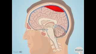 Subdural Hematoma [upl. by Coretta584]