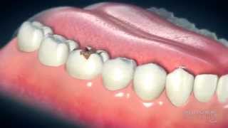 Dental Crowns Everything You Need to Know [upl. by Scevour]