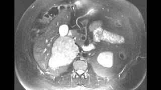 Adrenocortical Carcinoma [upl. by Riggs]