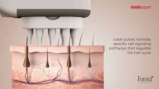 HAIRestart®  NonInvasive Laser Stimulation of Hair Growth [upl. by Nwahsem]