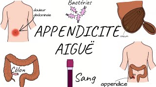 LAPPENDICITE AIGUË physiopathologie symptômes diagnostic traitement [upl. by Drarig426]