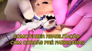 Reabilitação de dentes anteriores decíduos usando coroas pré fabricadas [upl. by Darmit]