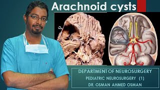 1 Arachnoid cysts First Part [upl. by Flam]