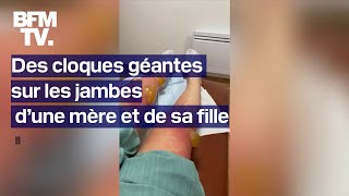 Des cloques géantes apparaissent sur les jambes d’une mère et de sa fille après une sortie au lac [upl. by Arakahs]