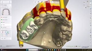 Cast Partial Denture Digital Design [upl. by Marillin696]