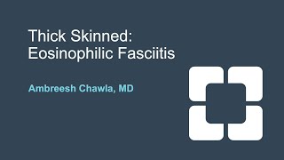 Diagnosis and Treatment of Eosinophilic Fasciitis [upl. by O'Driscoll]