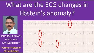 What are the ECG changes in Ebsteins anomaly [upl. by Messere]