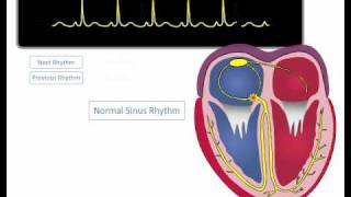 ECG Rhythm Review Sinus Rhythm Sinus Bradycardia Sinus Tachycardia [upl. by Cliff]