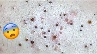 WHAT DO YOU THINK ABOUT THESE BLACKHEADS HOW WILL HE REMOVE IT 😨 relaxing blackheads [upl. by Richers]