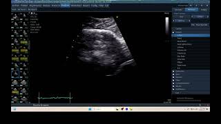 IQ 316 TCD BRAIN ULTRASOUND ECHOPAC ANALYSIS 1 [upl. by Nirek]