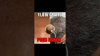 Over 11K Grafts Norwood 7 Hair Transplant Dr Pittella [upl. by Leirud206]