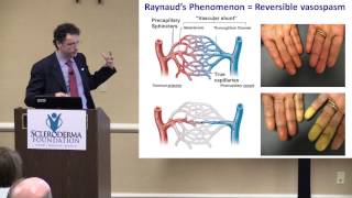 2015 Nashville The Scleroderma Hands and Their Care Dr Francesco Boin [upl. by Ganley]