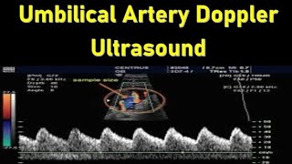 Umbilical Artery Doppler Ultrasound Interpretation  Doppler Ultrasound in Fetal Growth Assessment [upl. by Baryram796]