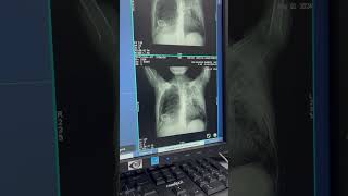 HRCT LUNGS SCANNING 🫁 [upl. by Marcella]