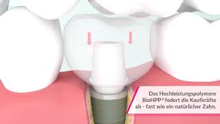 BioHPP neue Dimension in der prothetischen Versorgung von Implantaten [upl. by Cherida963]