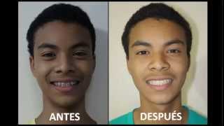 ORTODONCIA ANTES Y DESPUÉSPACIENTE CON DIASTEMA By DR JAVIER TOMALÁ ROSALES [upl. by Aillicec757]