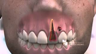 How to treat a dental Fistula [upl. by Aikahs]