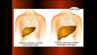 Salud ¿Qué es la hepatomegalia [upl. by Anaher]