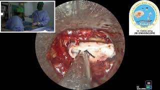 Rt L5S1 endo discectomy [upl. by Lawrenson]