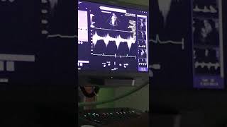 Echocardiogram heart murmur [upl. by Eissej]