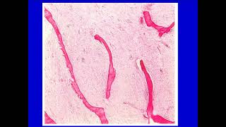 Síndromes Mieloproliferativos  Parte 1  Curso Residentado Médico  Hematología [upl. by Clayberg]